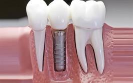 ساخت ایمپلنت‌های دندانپزشکی با ساختار نانو در ایران