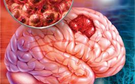 روشی جدید در تشخیص سریع تومور مغزی